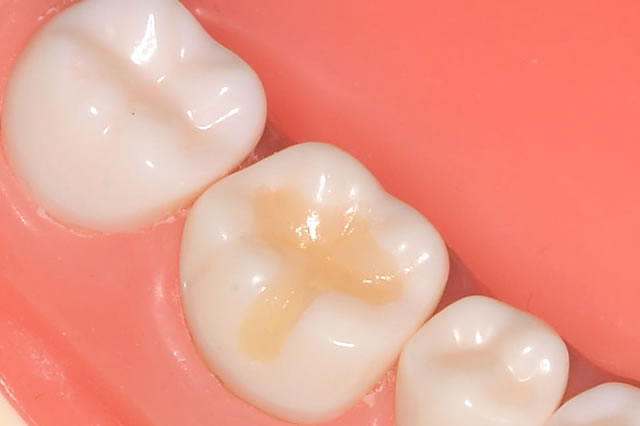 むし歯治療後の白い詰め物