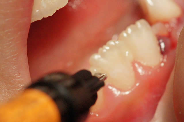 ぐらついた歯の治療